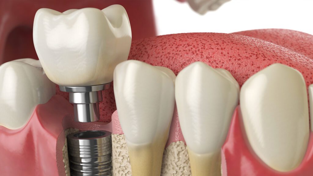 Dental Implant Metairie Dentist Dr. Ken Morgan