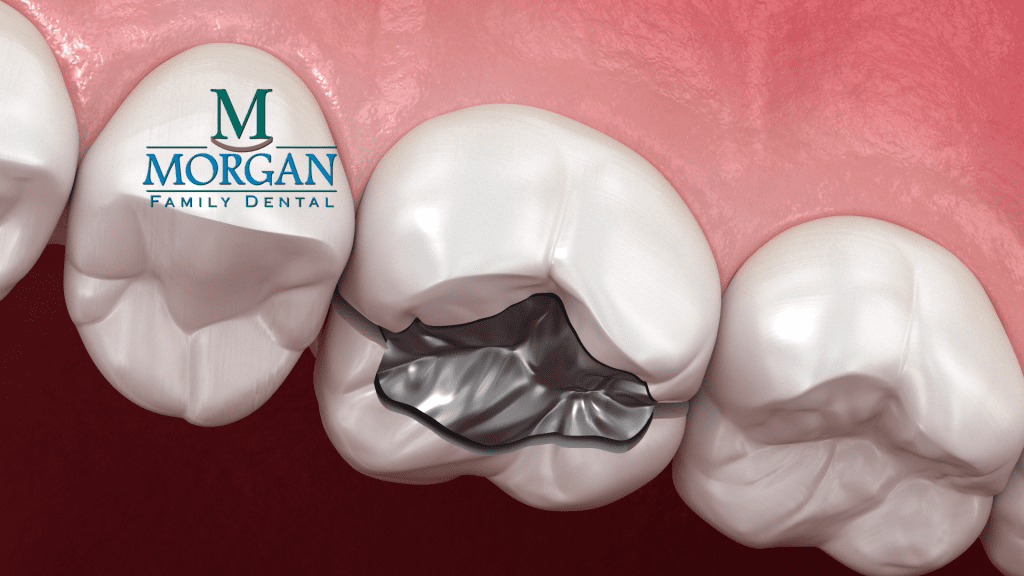Replace Amalgam Fillings with Dr. Ken Morgan for Better Dental Health