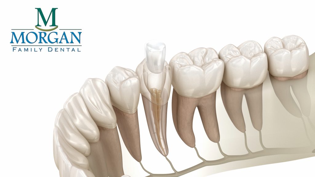 Choose Dr. Ken Morgan for Your Root Canal Therapy