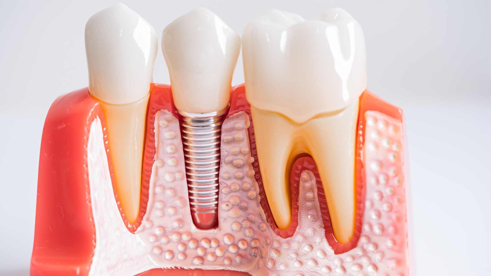 dental implants