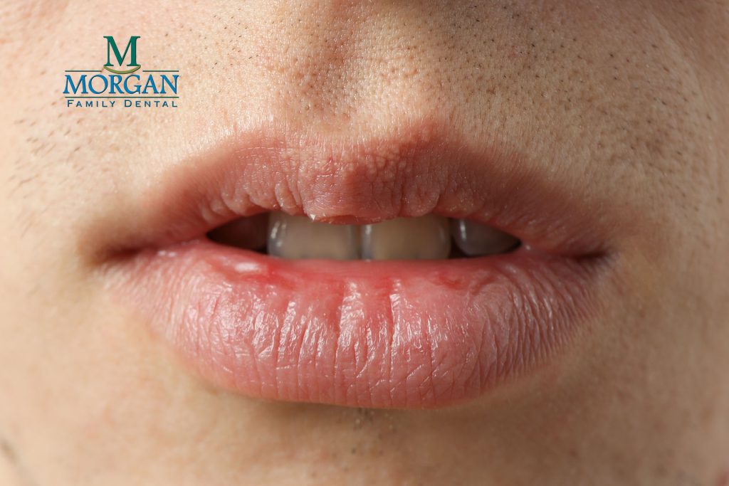 Living with Dry Mouth After Radiation Therapy