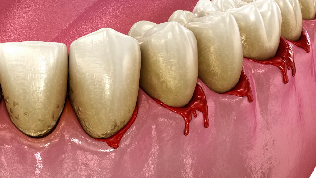 Bleeding Gums