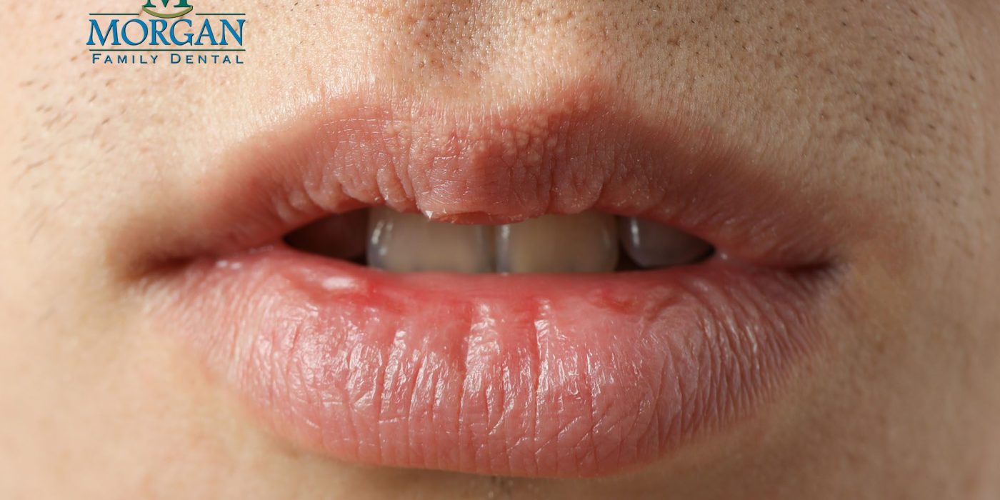 Living with Dry Mouth After Radiation Therapy