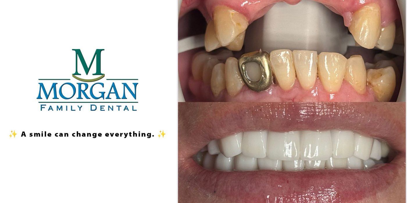 A Smile before and after smile transformation