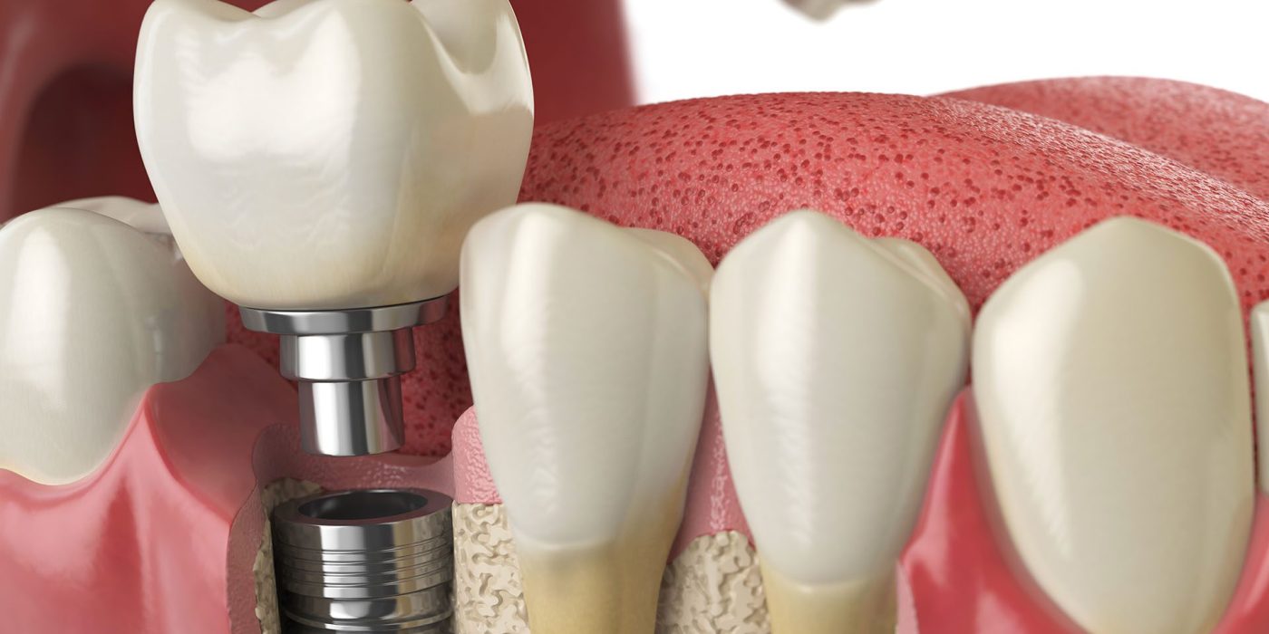 Dental Implant Metairie Dentist Dr. Ken Morgan