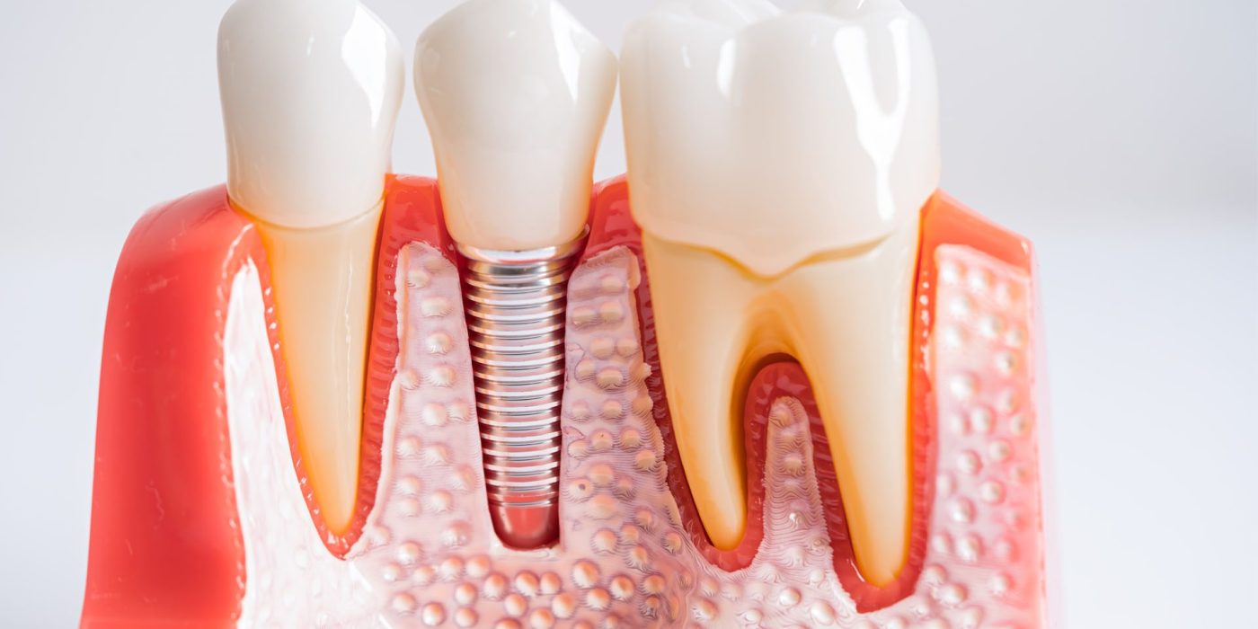 dental implants