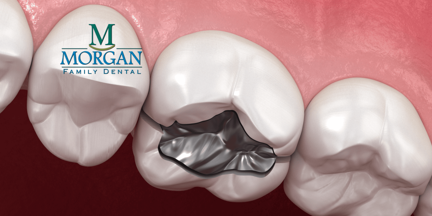 Replace Amalgam Fillings with Dr. Ken Morgan for Better Dental Health