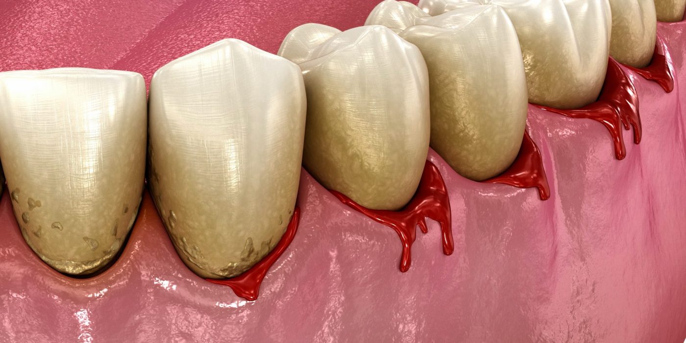bleeding-gums-or-periodontal-pathological-inflam-2025-08-29-1bleeding 1-31-04-utc.00_00_09_00.Still001 Bleeding Gums