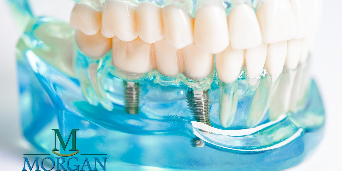 Implant-Supported Bridges: A Permanent Solution for Multiple Missing Teeth