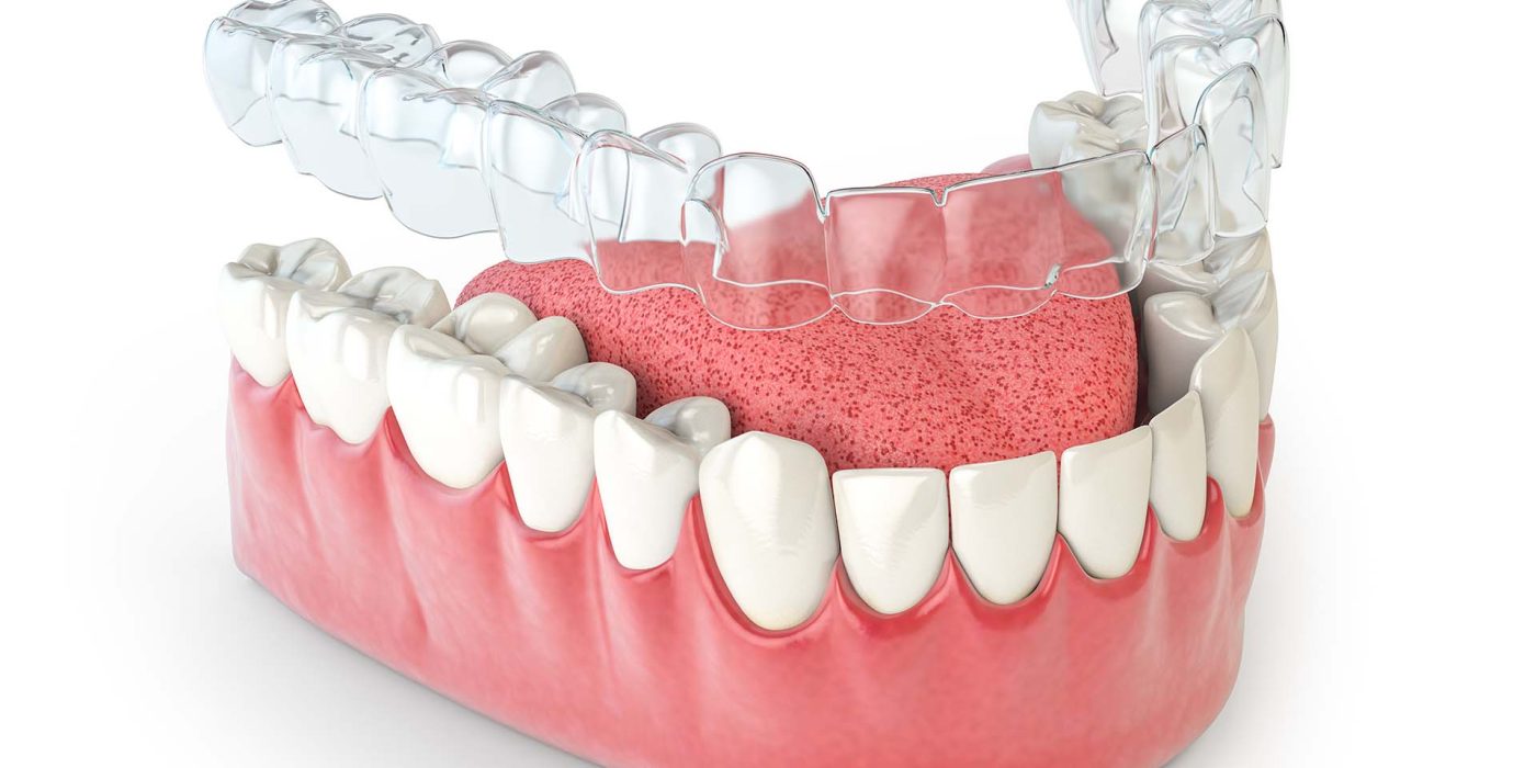 Invisalign Braces at Morgan Family Dental - Metairie, LA