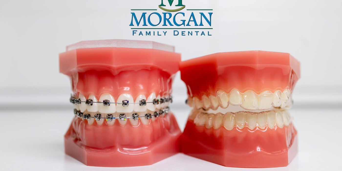 Invisalign vs traditional braces