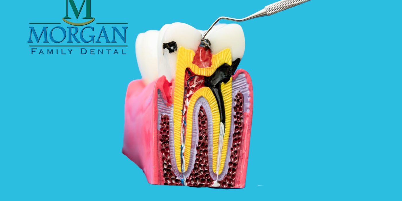 root canal Root Canal Therapy with Dr. Ken Morgan